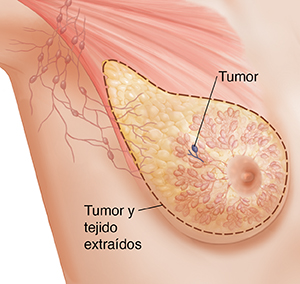 Vista de tres cuartos de la zona de una axila femenina donde puede verse la anatomía del seno en imagen fantasma. Se ve el contorno alrededor del tejido para una mastectomía simple.