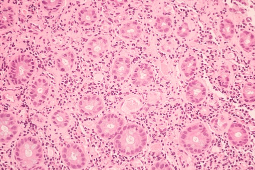 View in microscopic of ductal cell carcinoma